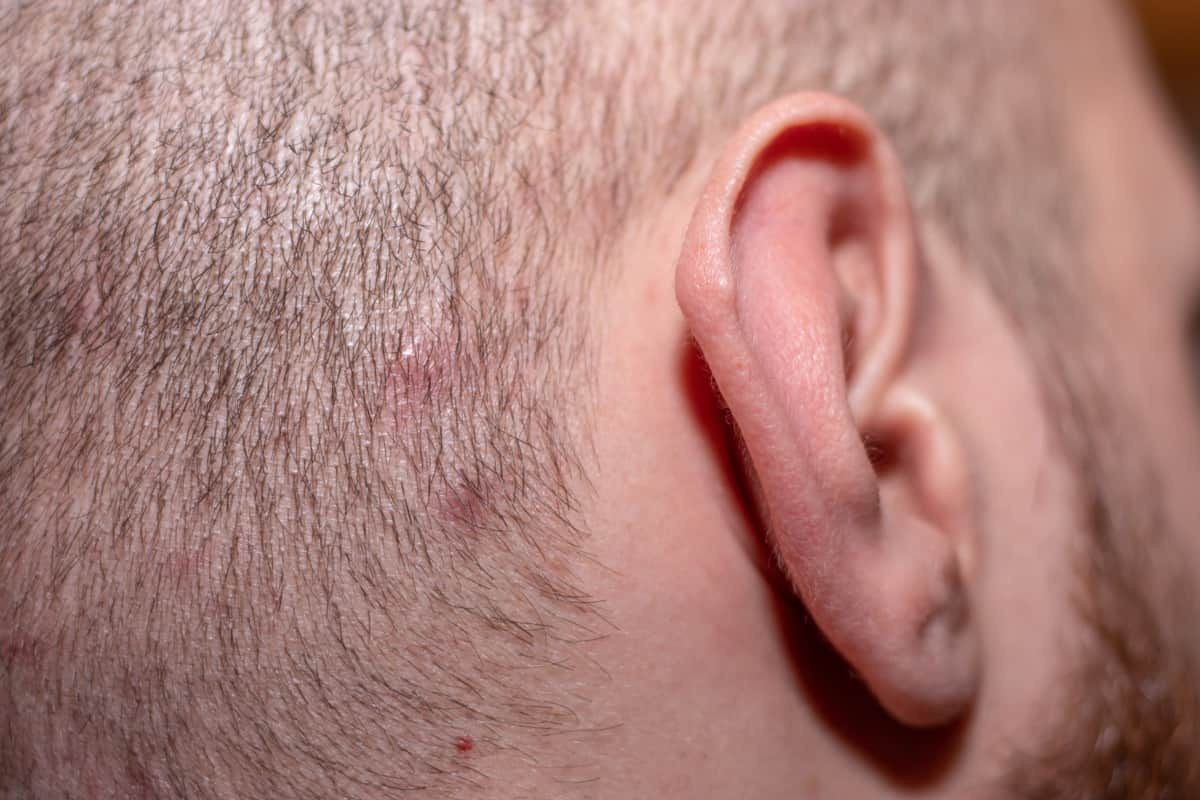 How To Get Rid Of Scalp Acne?